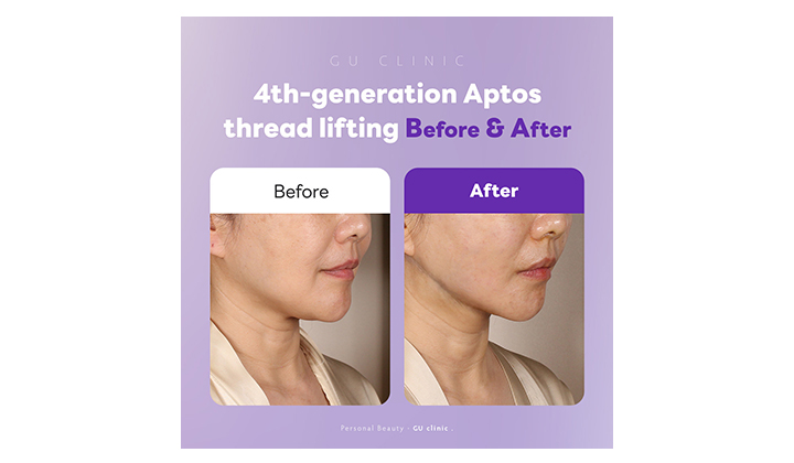 Why Choose Gangnam Station Aptos Thread Lift?