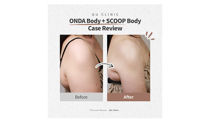 Stubborn Arm Fat: ONDA Body × Scoop Body