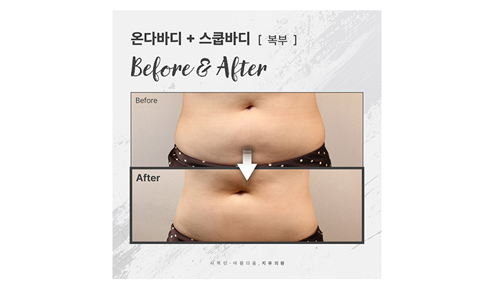 뱃살안빠짐이 고민이라면? 강남 온다바디·스쿱바디 사례
