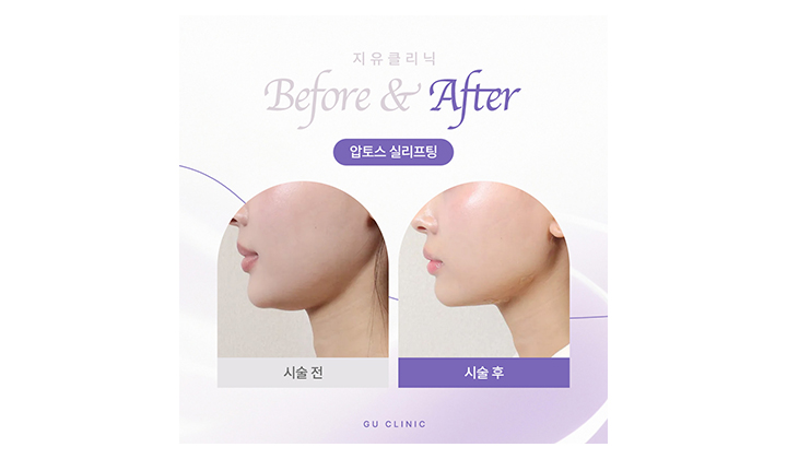 이중턱 정리를 위한 강남윤곽관리, 핵심은 무엇일까?
