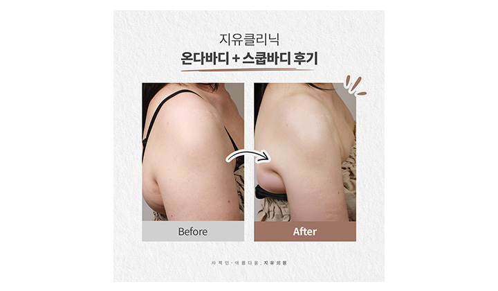 운동으로 안 빠지는 팔뚝 군살관리, 온다바디×스쿱바디 케이스