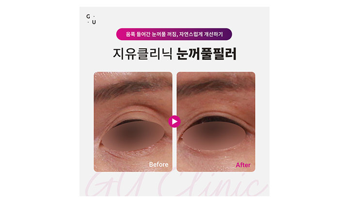눈꺼풀 꺼짐, 자연스러운 개선을 원한다면 강남역눈꺼풀필러
