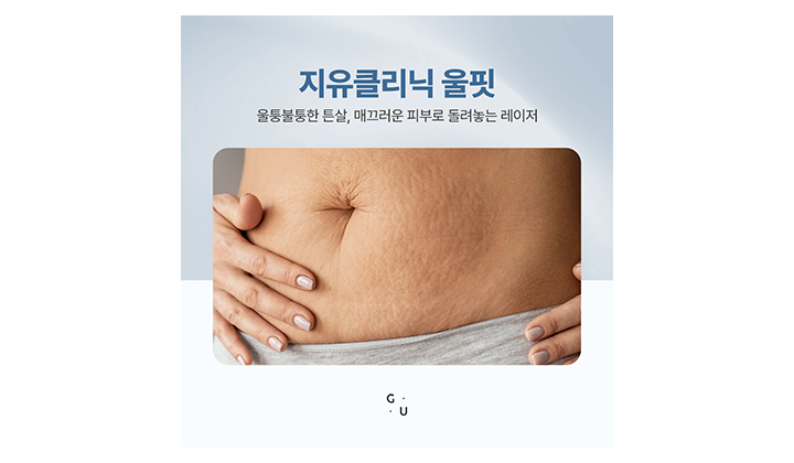 출산 후 튼살 관리, 일산출산튼살 케어 울핏으로 개선해보기