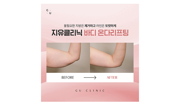 처진 팔뚝 라인을 다듬어주는 일산온다바디리프팅