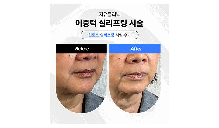 이중턱살 빼는 법, 일산 압토스로 바꾸는 턱선 라인