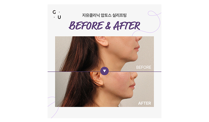 턱리프팅시술, 유지력까지 고려한다면 일산 압토스 실리프팅