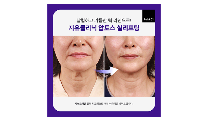 일산 4세대 압토스 실리프팅, 제거보다 정리에 초점을 맞춘