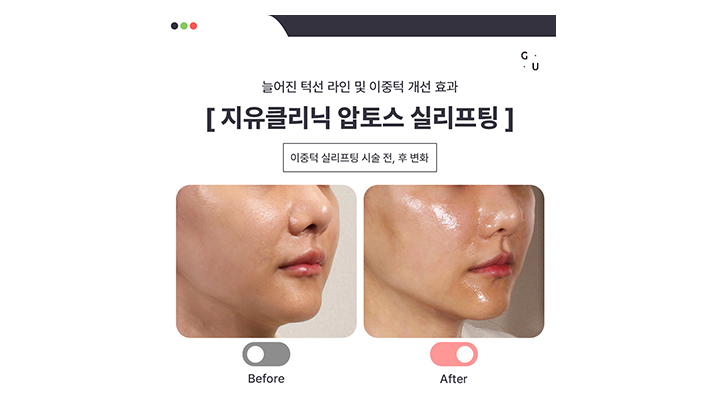 압토스 실리프팅, 후기만으로 결과를 평가해선 안됩니다